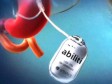 Rješenje za pretilost: Želučani pacemaker