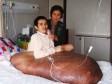 Video: Vijetnamac kojem su operisali tumor od 90 kg se oporavlja