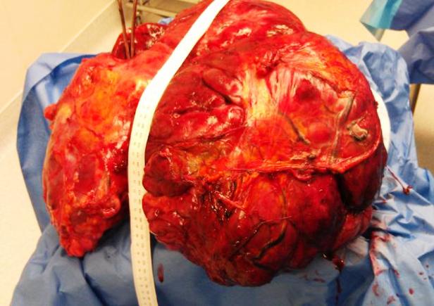 doctors-remove-51-pound-tumor-from-new-jersey-woman-2