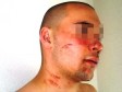 Foto: Izbacivači tukli mladića dok nije pao u nesvijest