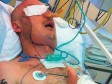 Foto/Rekordno brza operacija:  Vratili mu  lice 20 dana nakon nesreće